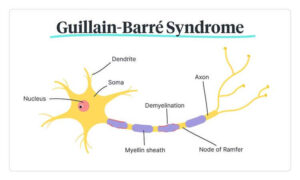 Guillain-Barré Syndrome Wiki (January 2022) Know The Authentic Details!