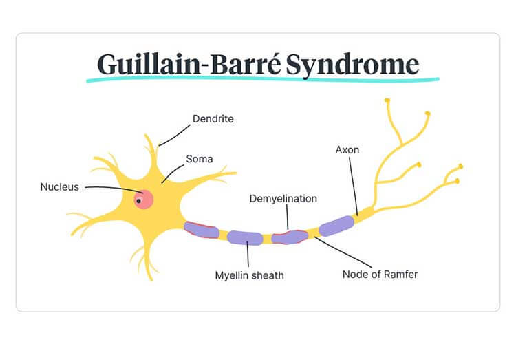 Guillain-Barré Syndrome Wiki (January 2022) Know The Authentic Details!